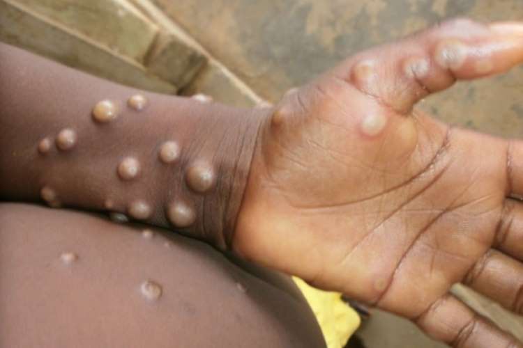 Rising monkeypox cases across the world