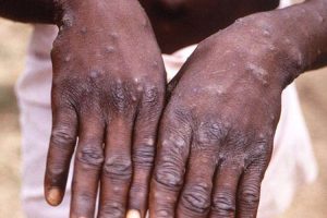 The world facing monkeypox threat